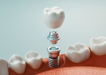 a 3D illustration of a dental implant and abutment