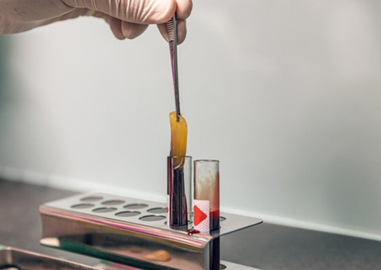 periodontist holding platelet-rich fibrin 