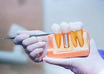 Dentist pointing to a dental implant model