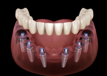 Animated smile during dental implant supported denture placement