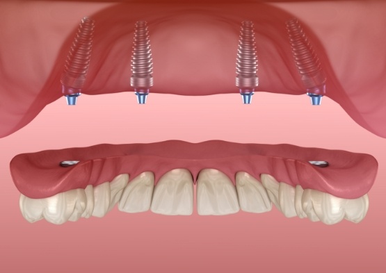 Animated all on four implant denture placement