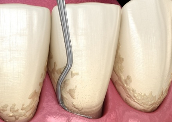 Animated smile during scaling and root planing periodontal therapy