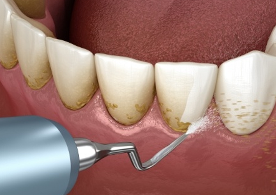 Animated smile during periodontal deep cleaning