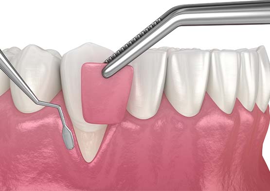 Animated smile during gum grafting treatment