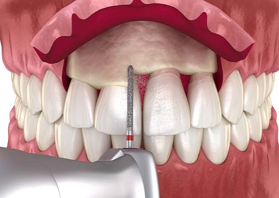 Animated smile during crown lengthening treatment