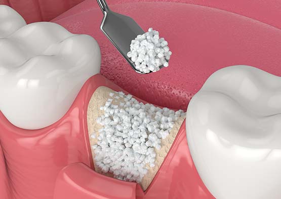 Animated smile during socket preservation treatment