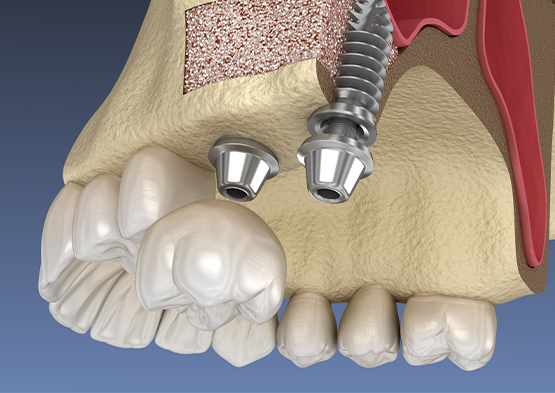 Animated smile after sinus lift