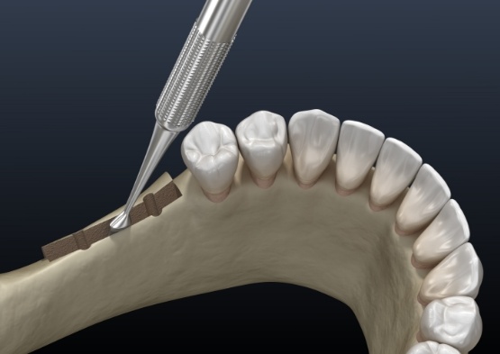 Animated smile during ridge augmentation