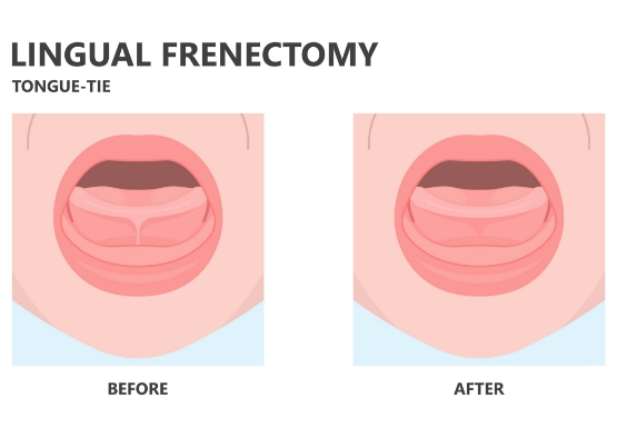 Animated smile before and after frenectomy for lip and tongue tie correction