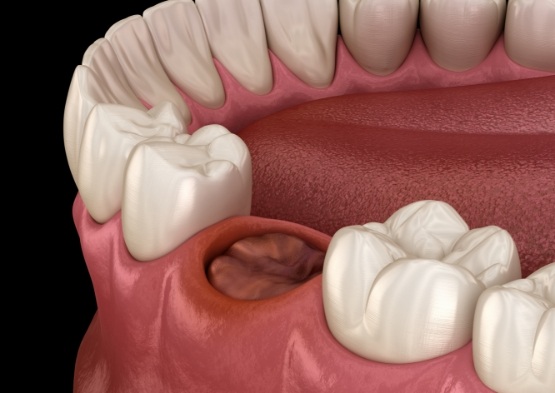 Animated smile after tooth extractions