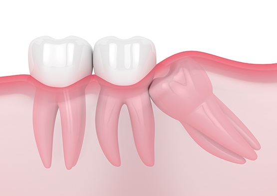Illustration of wisdom tooth growing in sideways