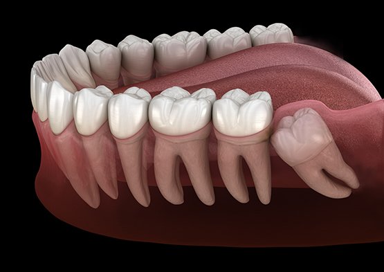 Illustration of wisdom tooth growing in