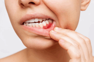 Woman pulling back her lip to reveal inflamed gums